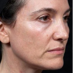 Thermage Before & After Patient #1588